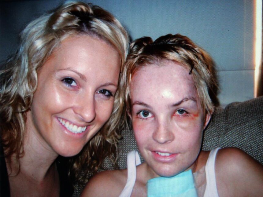 Lauren Huxley with sister Simone after reconstructive surgery